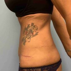 Renuvion Before & After Patient #10983