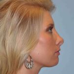 Nose Surgery Before & After Patient #10990