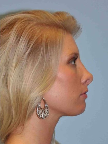 Nose Surgery Before & After Patient #10990