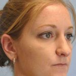 Nose Surgery Before & After Patient #10997