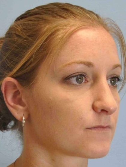 Nose Surgery Before & After Patient #10997