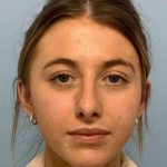 Nose Surgery Before & After Patient #11004