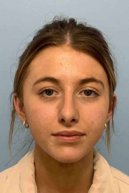 Nose Surgery Before & After Patient #11004