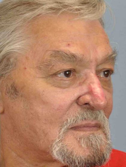 Nose Surgery Before & After Patient #11011