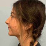 Nose Surgery Before & After Patient #11025