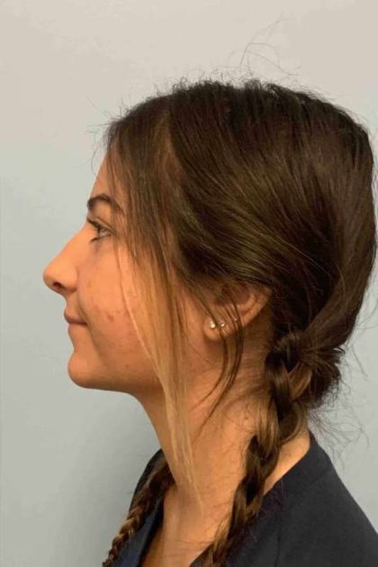 Nose Surgery Before & After Patient #11025
