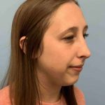 Nose Surgery Before & After Patient #11032