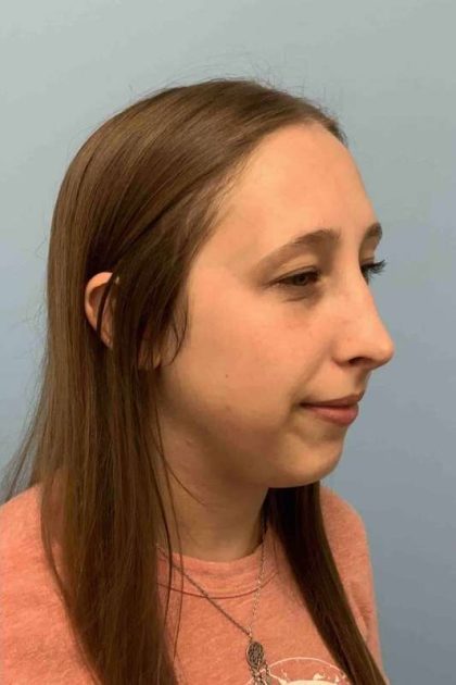 Nose Surgery Before & After Patient #11032