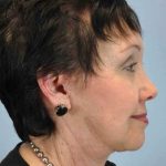 Neck Lift Before & After Patient #11039