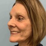 Neck Lift Before & After Patient #11053