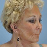 Neck Lift Before & After Patient #11069