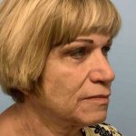 Neck Lift Before & After Patient #11092