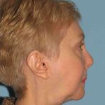 Neck Lift Before & After Patient #11104