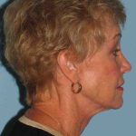 Neck Lift Before & After Patient #11111
