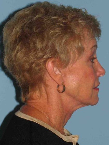 Neck Lift Before & After Patient #11111