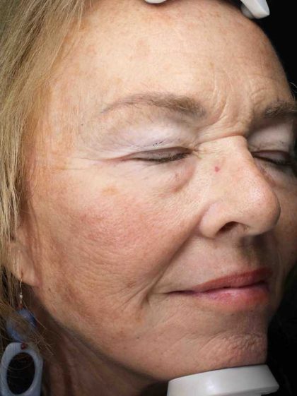 Neck Lift Before & After Patient #11127