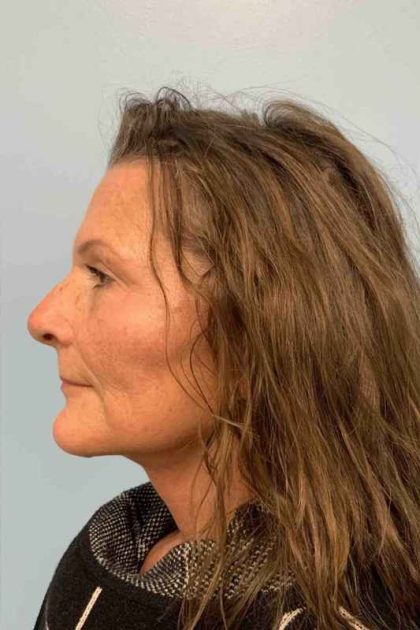 Neck Lift Before & After Patient #11134