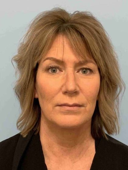 Neck Lift Before & After Patient #11145