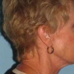 Lip Augmentation Before & After Patient #11160