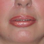 Lip Augmentation Before & After Patient #11175