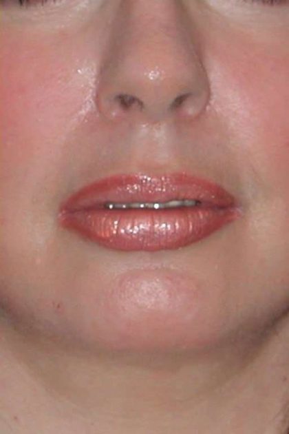 Lip Augmentation Before & After Patient #11175