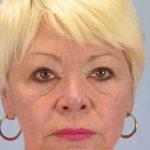 Laser Resurfacing Before & After Patient #11192