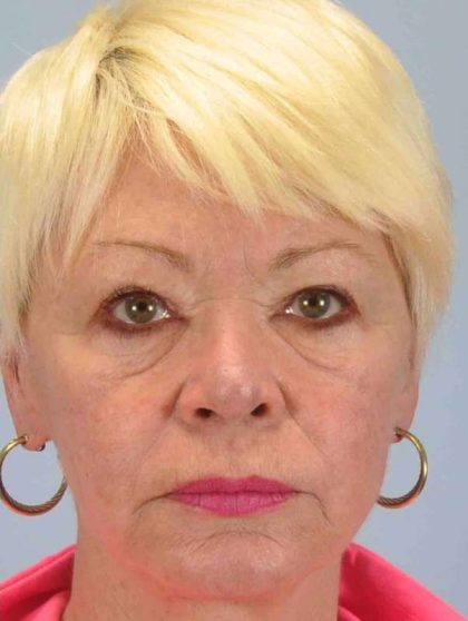Laser Resurfacing Before & After Patient #11192