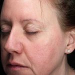 Laser Resurfacing Before & After Patient #11197