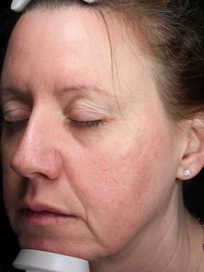 Laser Resurfacing Before & After Patient #11197