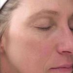 Laser Resurfacing Before & After Patient #11215