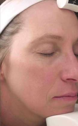 Laser Resurfacing Before & After Patient #11215