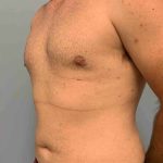 Gynecomastia Before & After Patient #11237