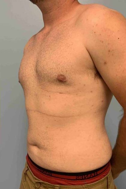 Gynecomastia Before & After Patient #11237