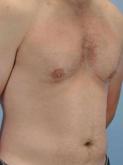 Gynecomastia Before & After Patient #11260