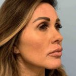 Fillers Before & After Patient #11283