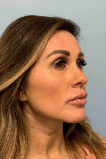Fillers Before & After Patient #11283