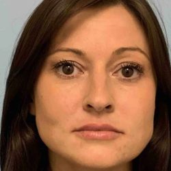 Fillers Before & After Patient #11288