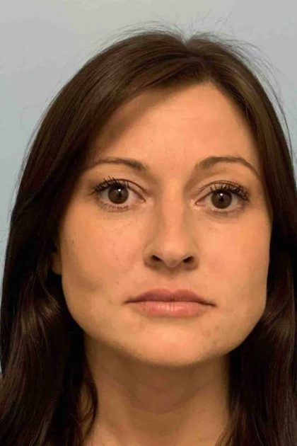 Fillers Before & After Patient #11288