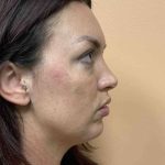 Fillers Before & After Patient #11298