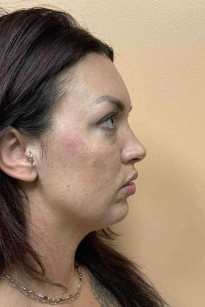 Fillers Before & After Patient #11298