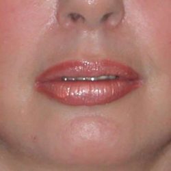 Fat Injections Before & After Patient #11326