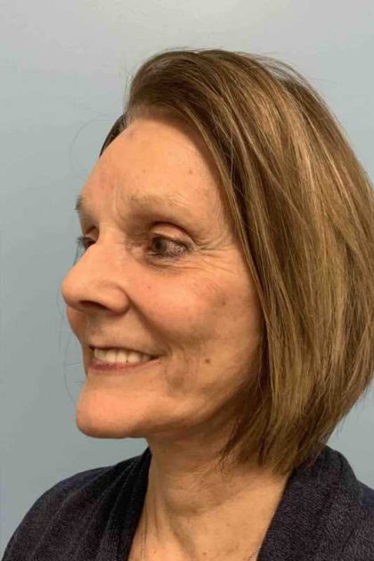 Fat Injections Before & After Patient #11347
