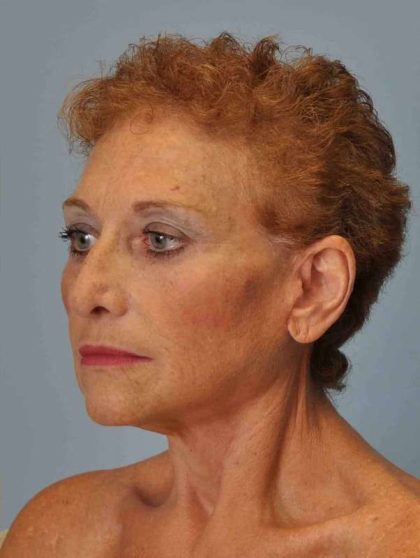 Facelift Before & After Patient #11371