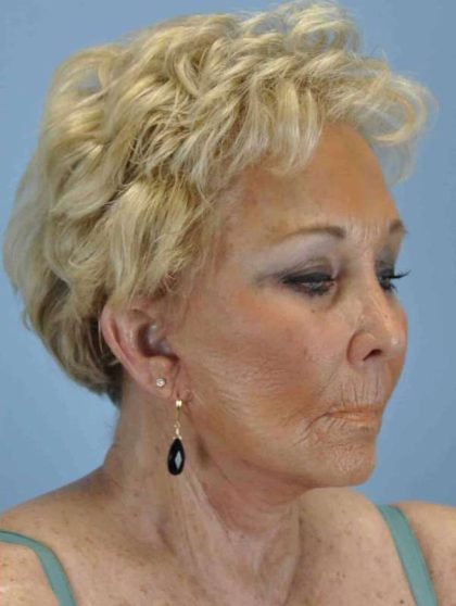 Facelift Before & After Patient #11380
