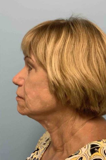 Facelift Before & After Patient #11389