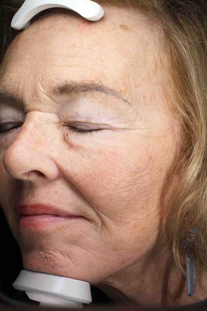 Facelift Before & After Patient #11410