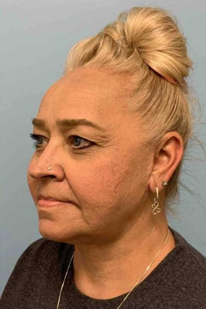 Facelift Before & After Patient #11424