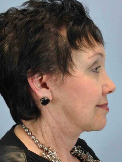 Facelift Before & After Patient #11431