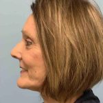 Facelift Before & After Patient #11443