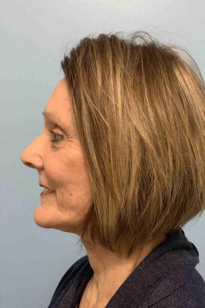 Facelift Before & After Patient #11443